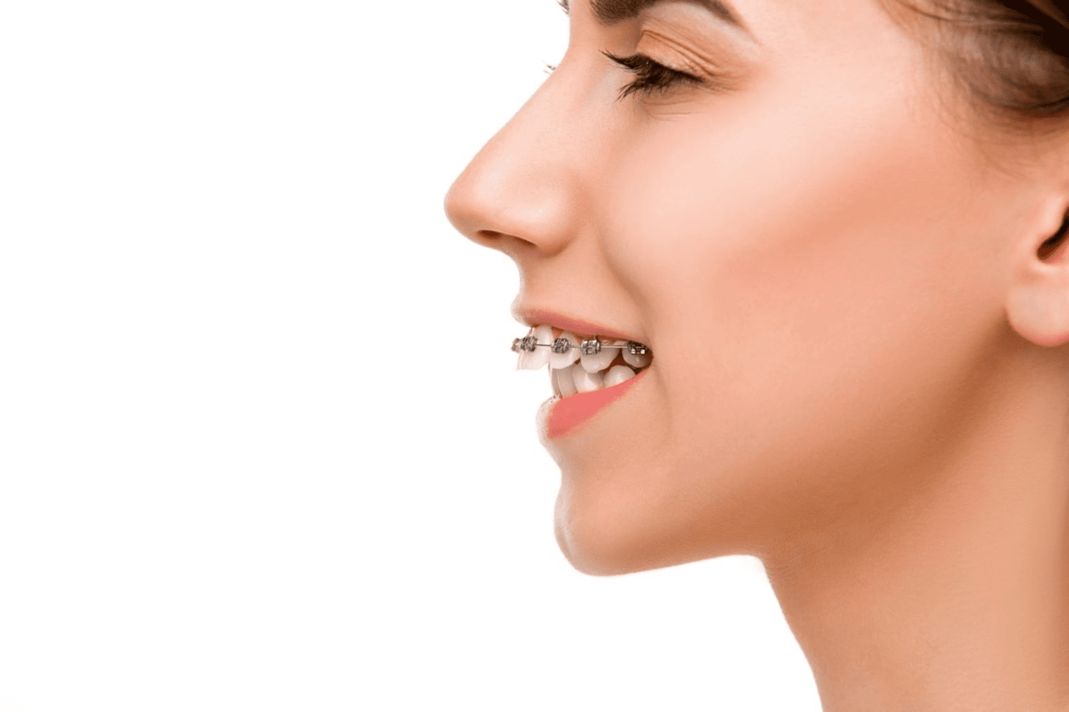 Correcting Overbites with Invisalign An Overview