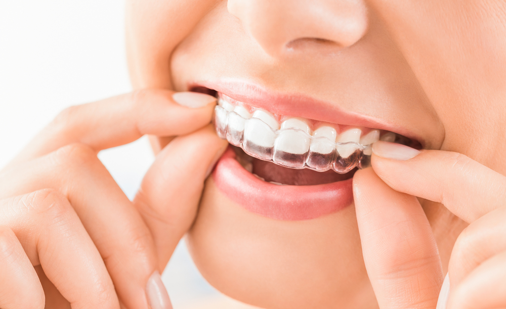 Tips for Cleaning Invisalign Retainers Effectively